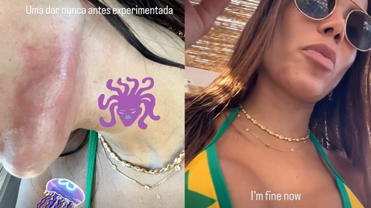 Queimadura de água-viva pode massacrar? Saiba linha que Anitta correu ao testilhar com uma