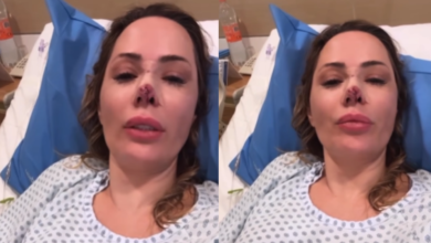 Influenciadora é atacada por cachorro e passa por cirurgia: “Reconstruí o nariz“